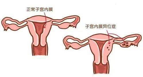 忻州和美妇科医院段文蓉介绍：治疗盆腔炎需要手术吗